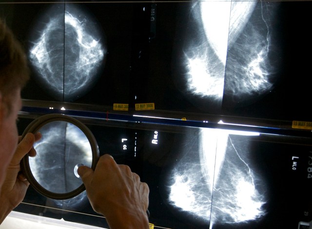 Breast cancer diagnoses ticking up among young women, Asian Americans: Research